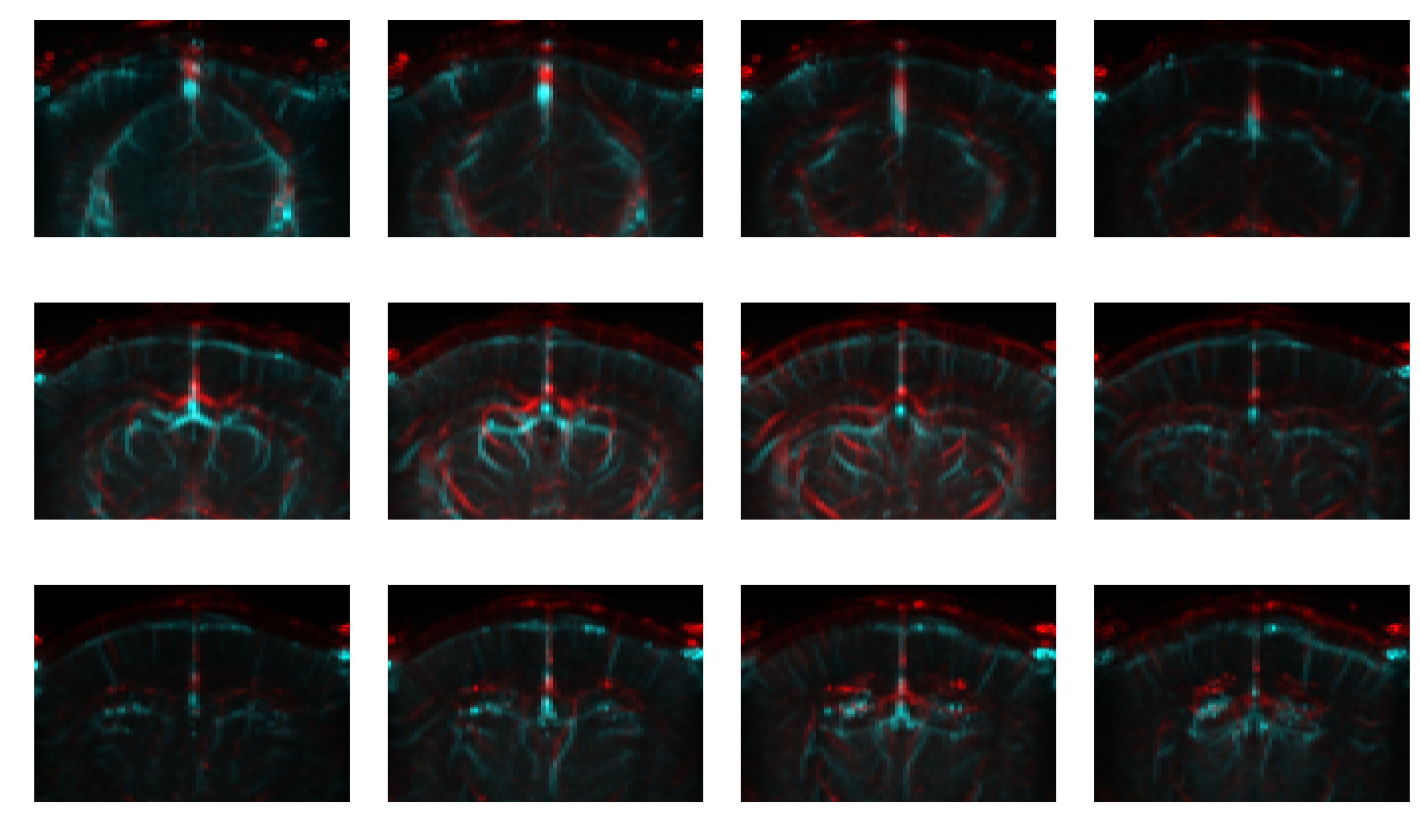 Red/cyan composite of two angiography sessions
