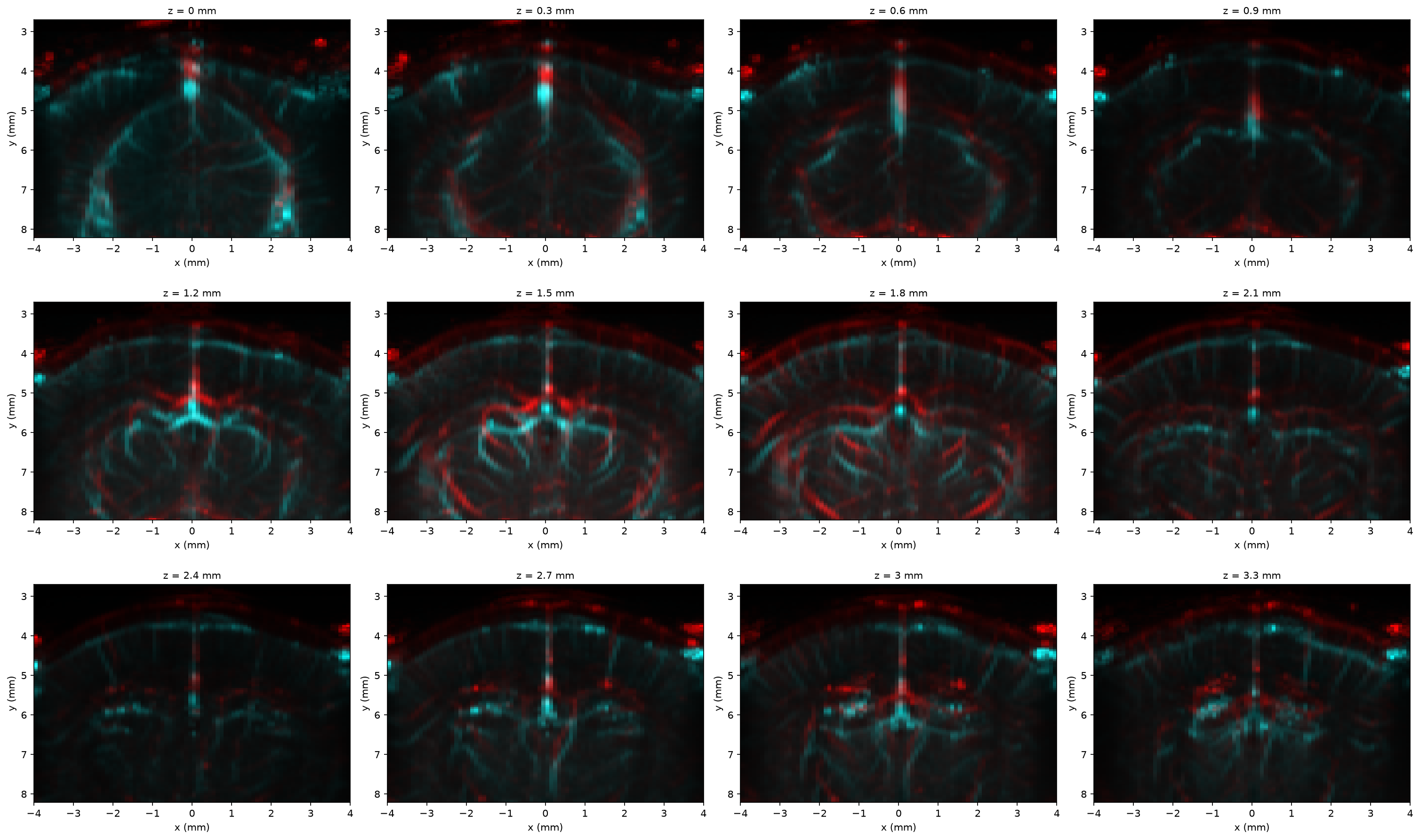 Red/cyan composite of two angiography sessions