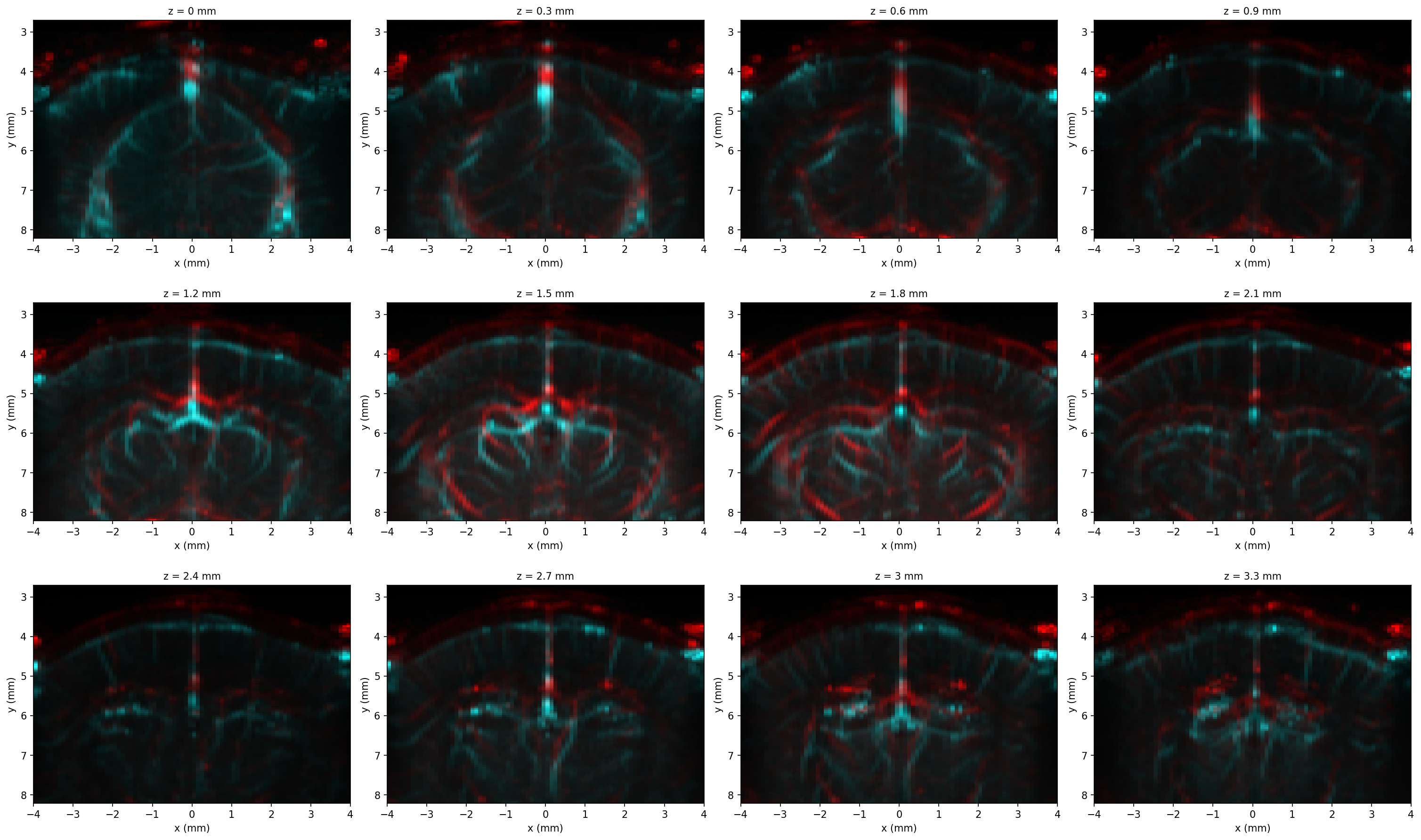 Red/cyan composite of two angiography sessions