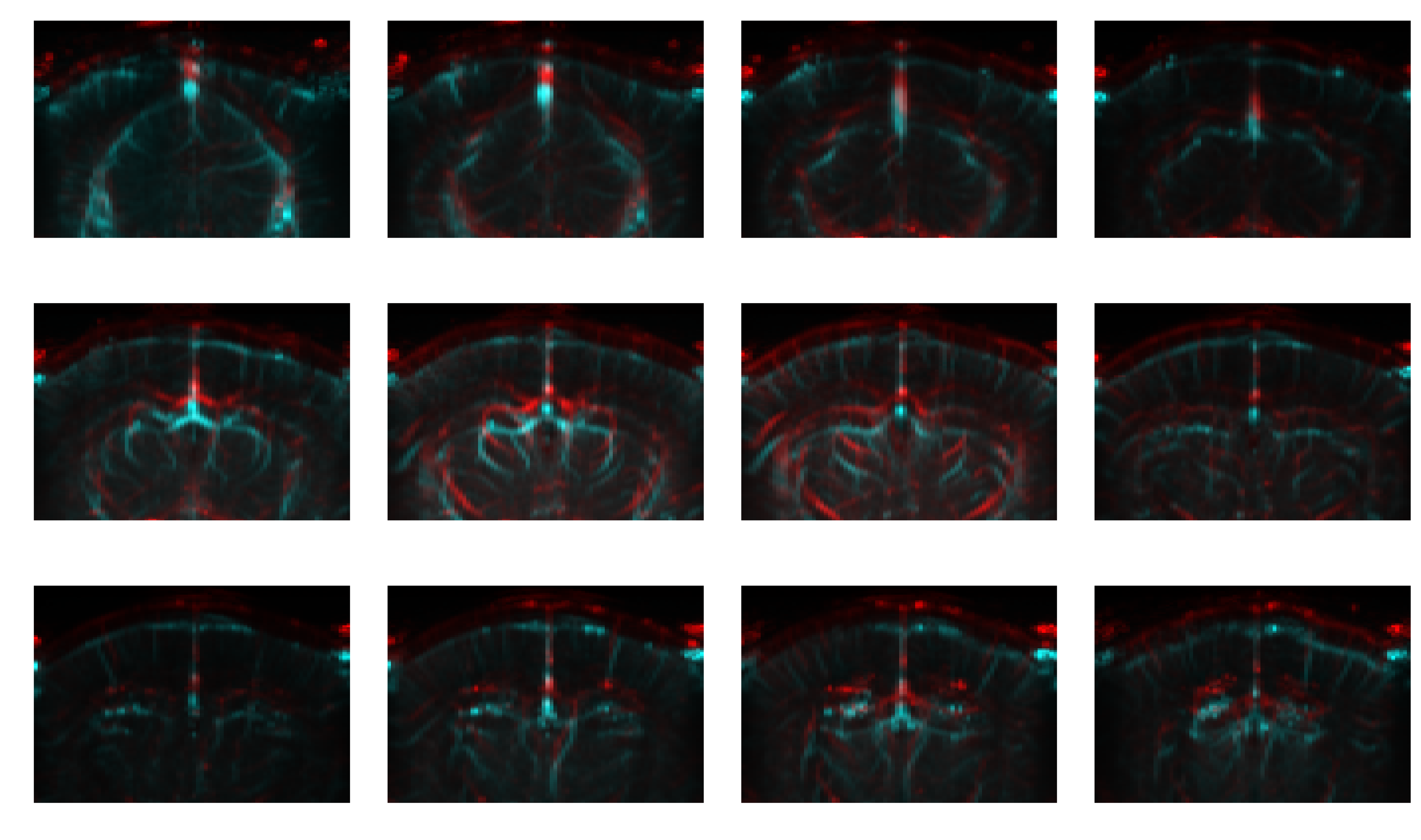 Red/cyan composite of two angiography sessions
