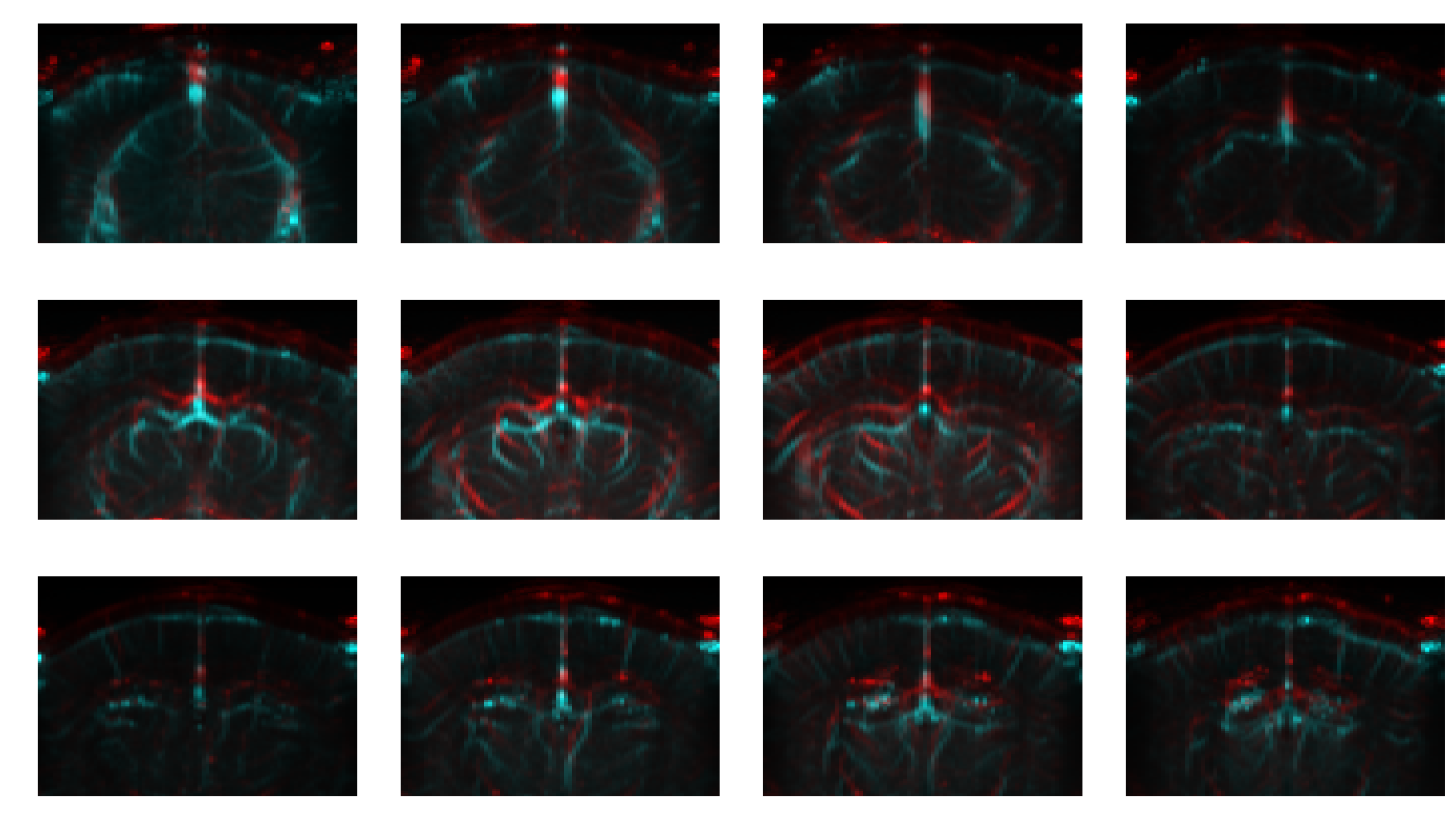 Red/cyan composite of two angiography sessions
