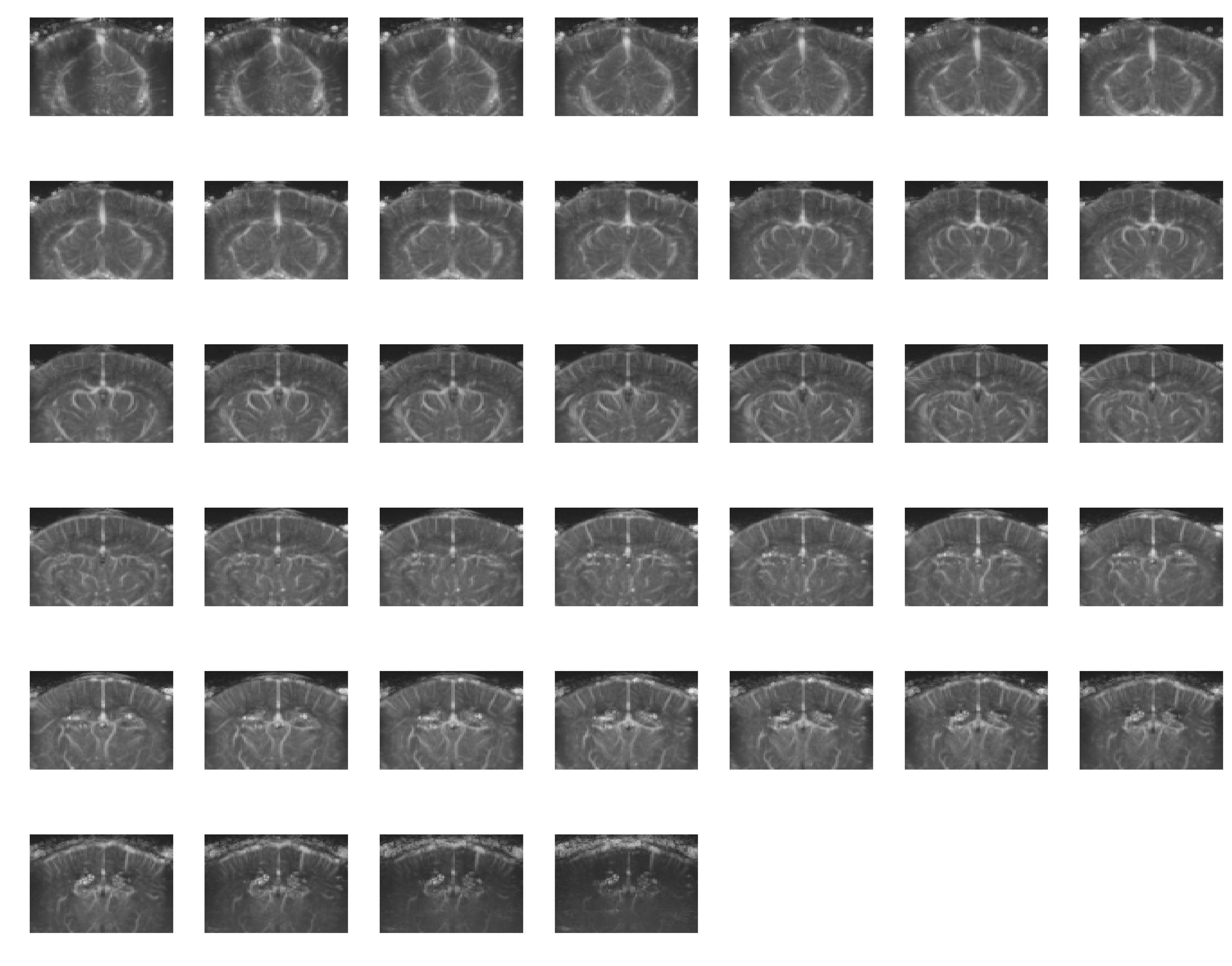 3D angiography volume shown as an elevation-slice grid